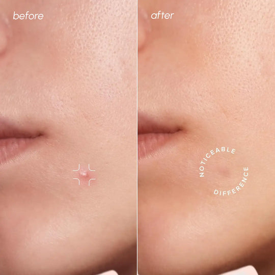 Invisible Hydrocolloid Patch