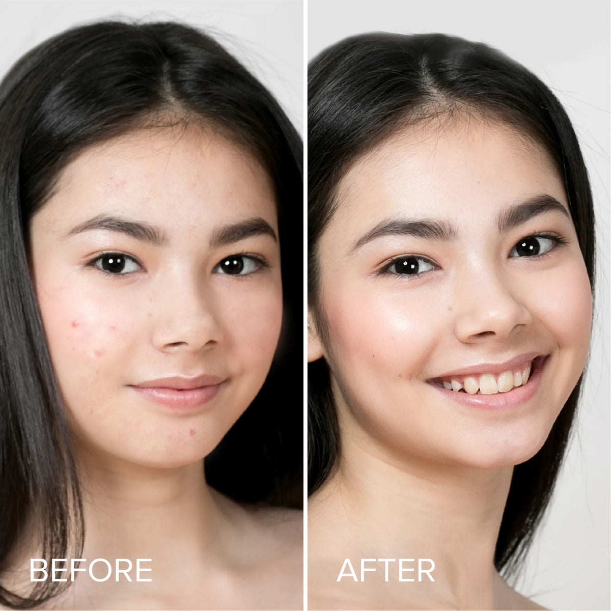 MARÉE Pimple & Acne Patches