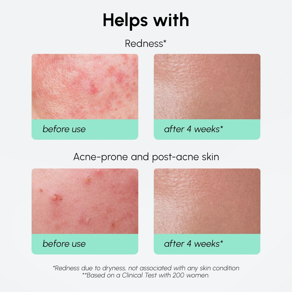 Redness Soothing Azelaic Acid Serum