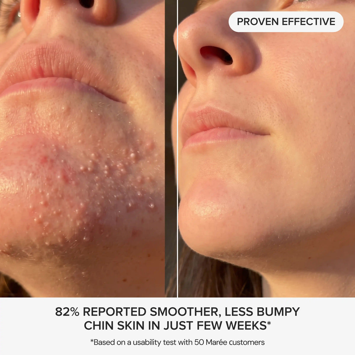 Glycolic Pads for Chin Bumps & Breakouts