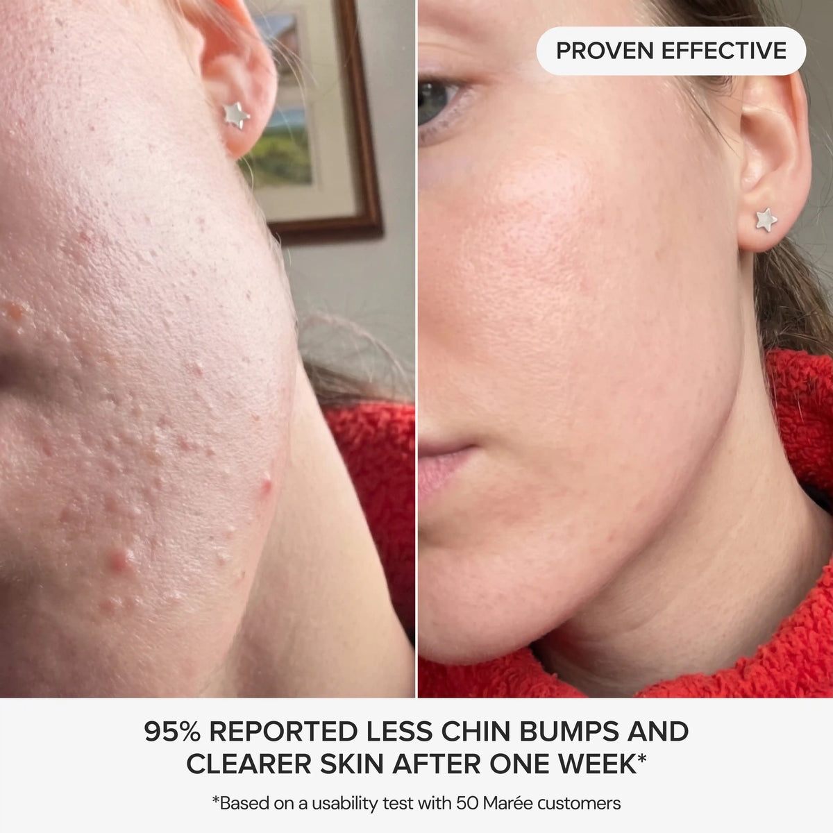 Glycolic Pads for Chin Bumps & Breakouts